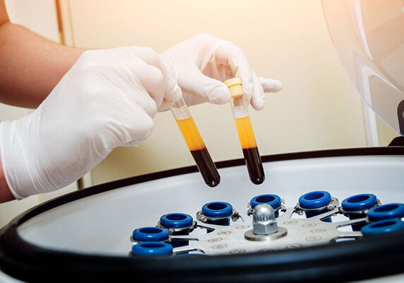Platelet-Rich-Plasma-PRP-